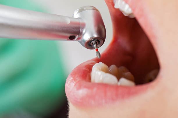 Best Emergency Root Canal Treatment in East Liverpool, OH